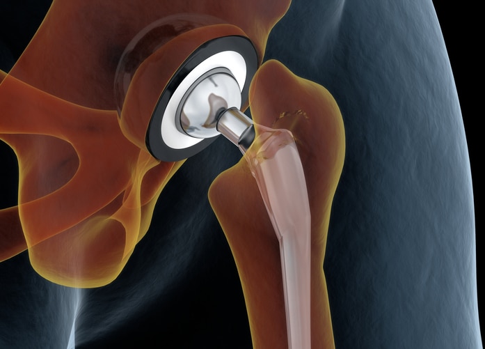 Joint Replacement (Knee, Hip) Elbow / Shoulder